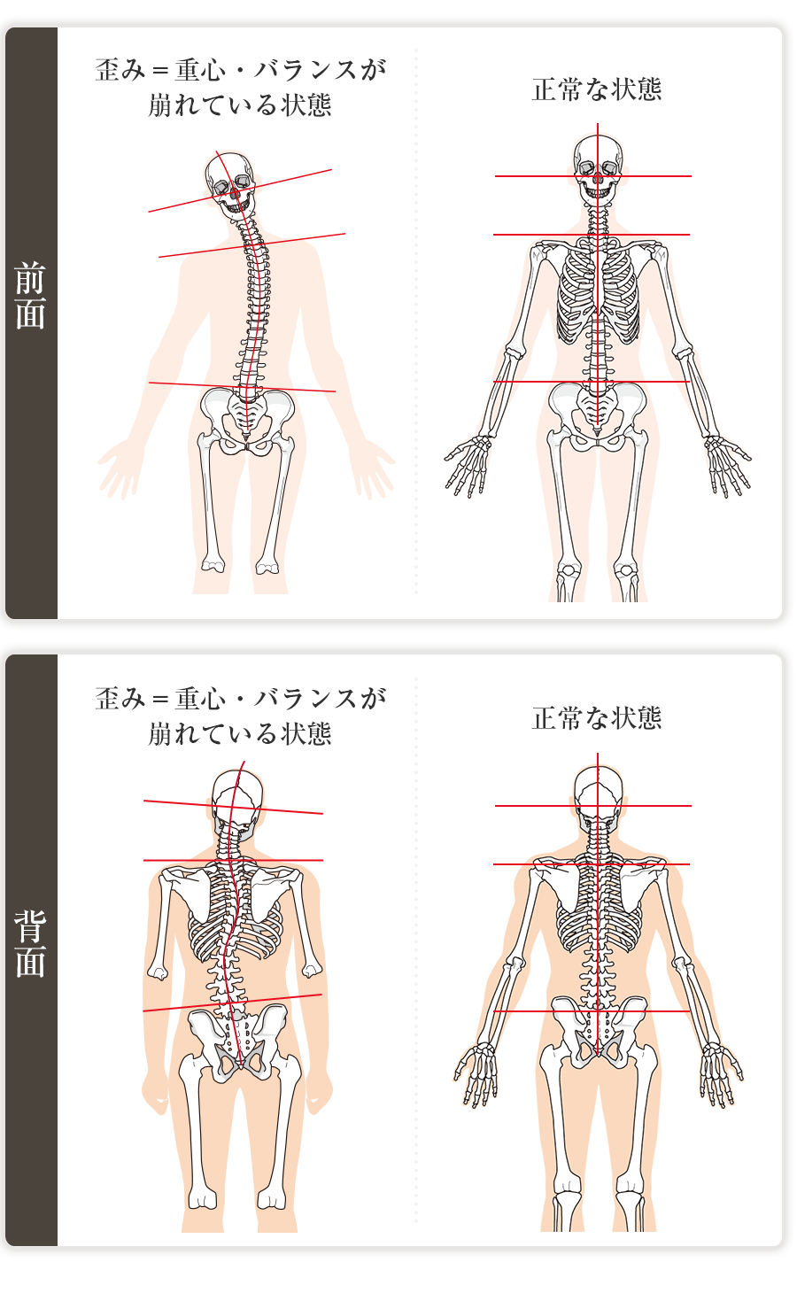 人体の歪みのある状態と正常な状態の比較図